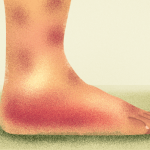 View of a swollen and bruised ankle, ankle sprain symptoms and signs