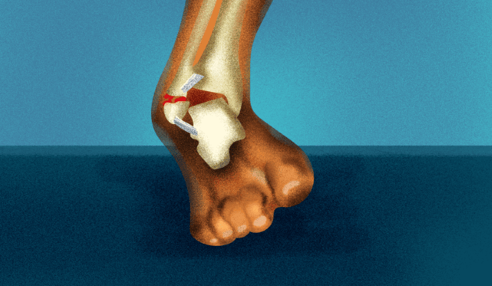 An ankle joint fracture
