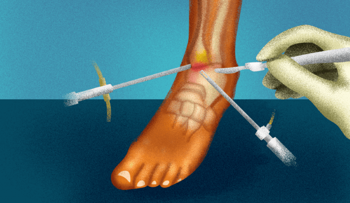 All About Ankle Sprain Types Causes Treatments And More