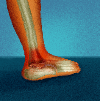 Osteoarthritis ankle injuries