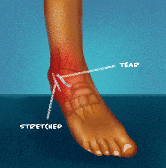 Tendinitis of the ankle treatment and causes